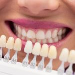 Descubre las maravillas de las carillas dentales