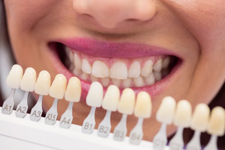 Descubre las maravillas de las carillas dentales